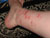 Picture of BedBug Bite On Leg